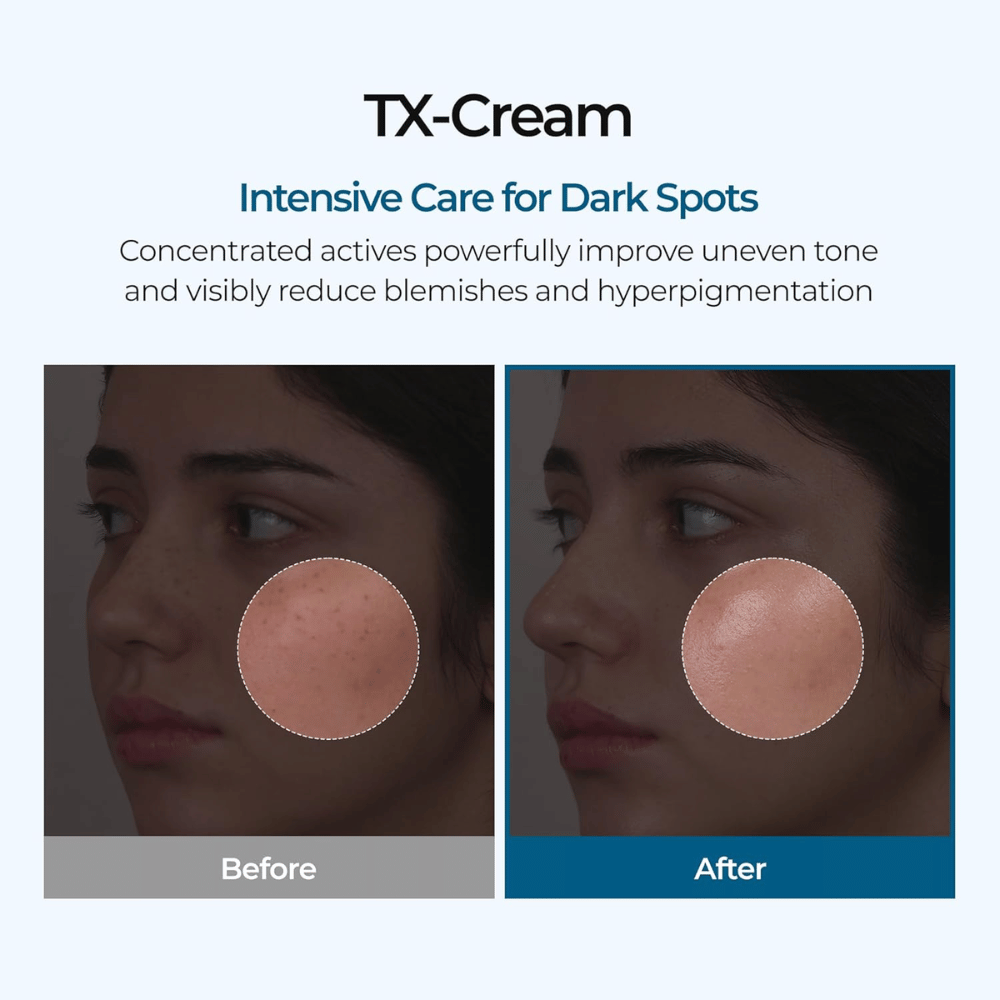 Før- og efterresultater med TX Cream, som reducerer mørke pletter og ujævn hudtone for en synligt klarere og mere ensartet hud